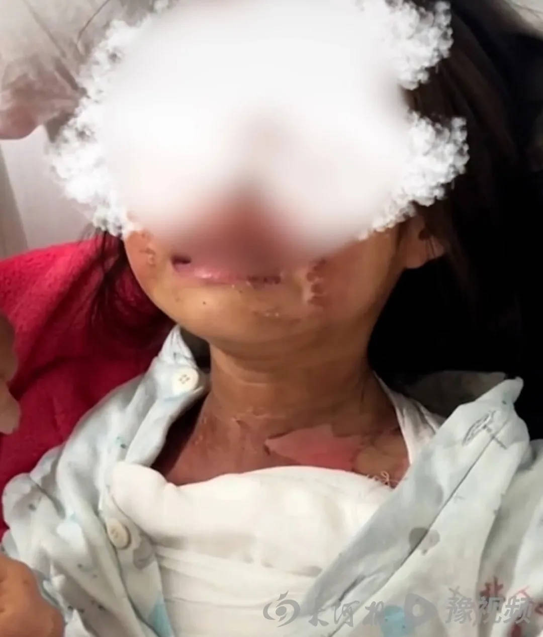 广东被高年级男生泼开水女童已返校<strong></p>
<p>TREX</strong>，家长称多人被处理