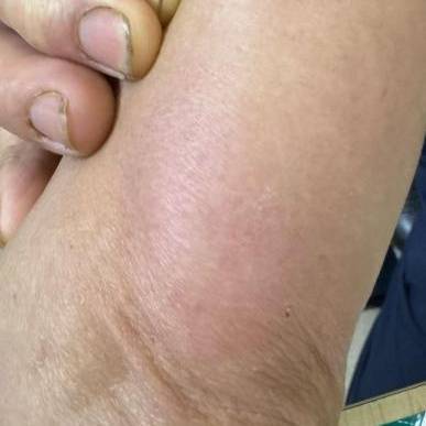 杭州发生多起<strong></p>
<p>TradeSatoshi</strong>！面部肿成“馒头”！6小时内处理很重要